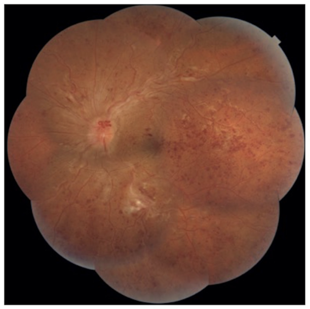 Montage fundus photo of central retinal vein occlusion