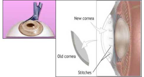 What is Corneal Transplantation?